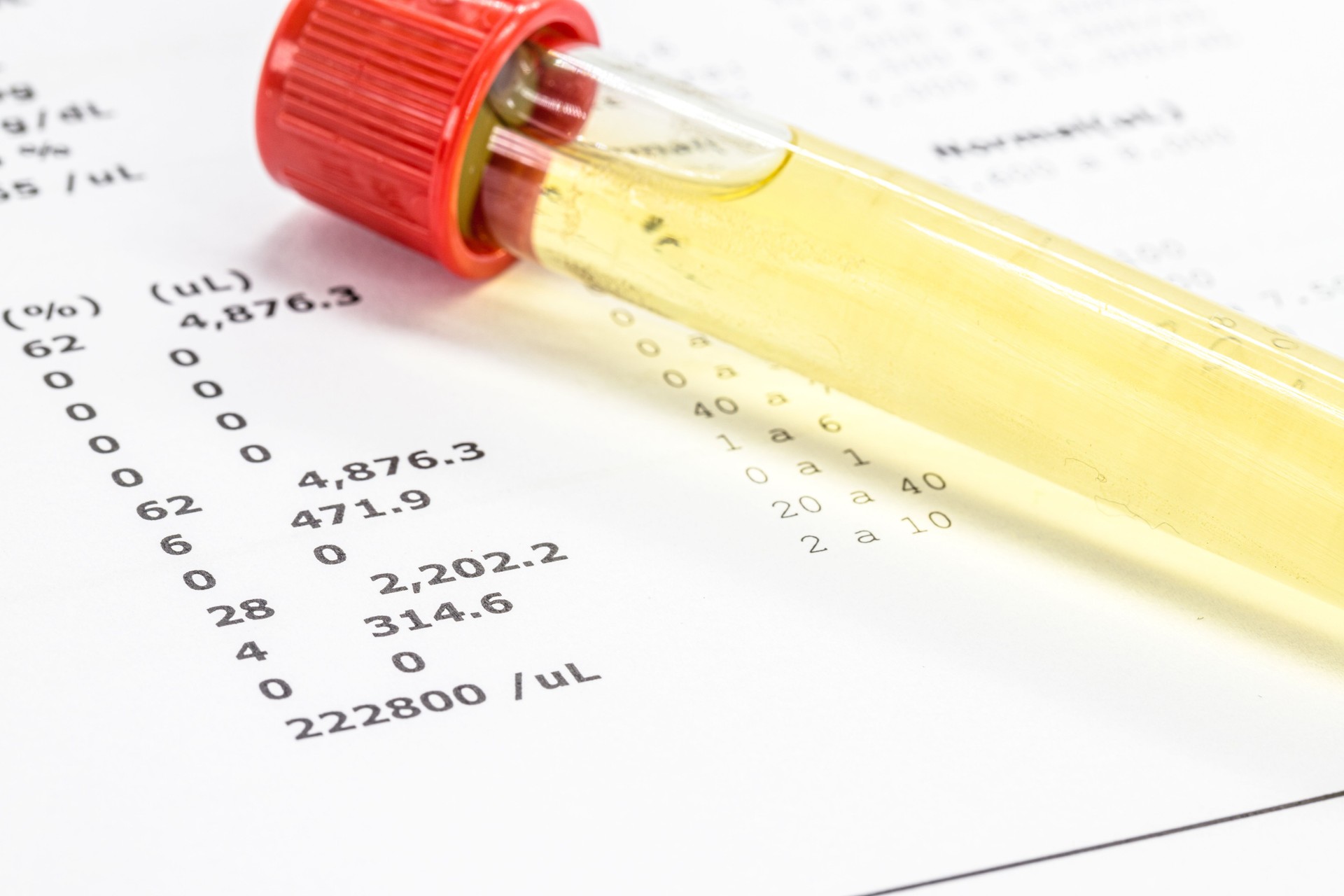 urine vial in laboratory, toxicology or routine examination